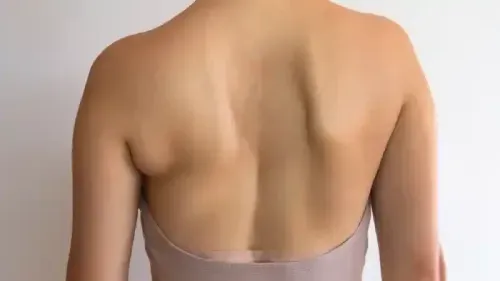 Scoliosis Surgery Cost India: What to Expect